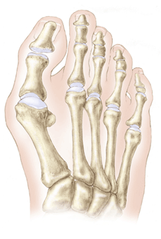 hallux valgus